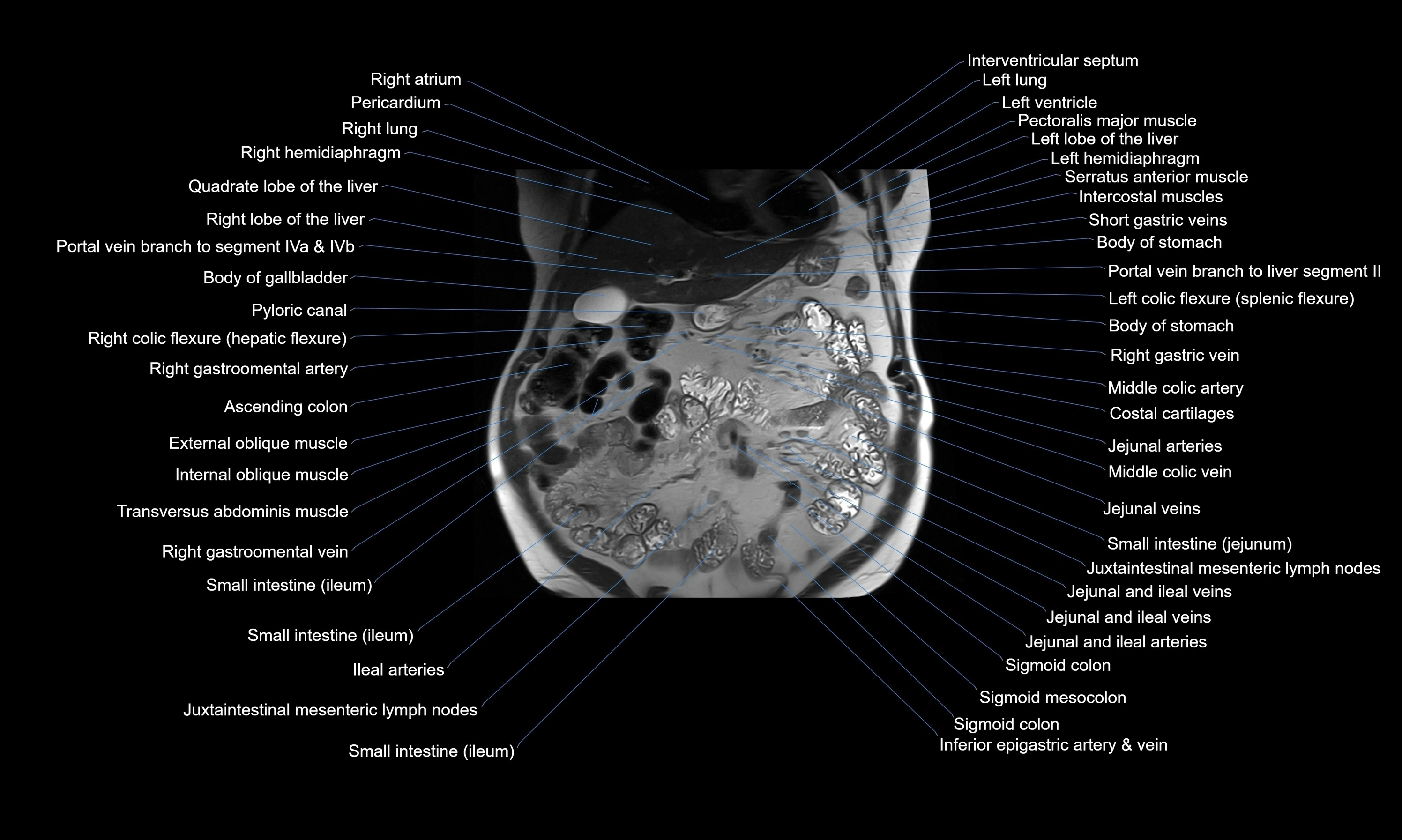 MRI Abdomen axial cross sectional anatomy radiology  image-img-00001-00020.webp